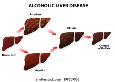 Alcoholic Liver Disease. Fatty Liver, Fibrosis, Hepatitis, Cirrhosis Of The Liver. Illustration. Any Kind Of Alcohol Can Cause Liver Damage.