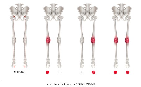 Alignment of normal leg bone or neutral stance leg bone anterior view red highlights in arthritis Knee joint pain area-3D Medical illustration- Human Anatomy and Medical Concept-on white background