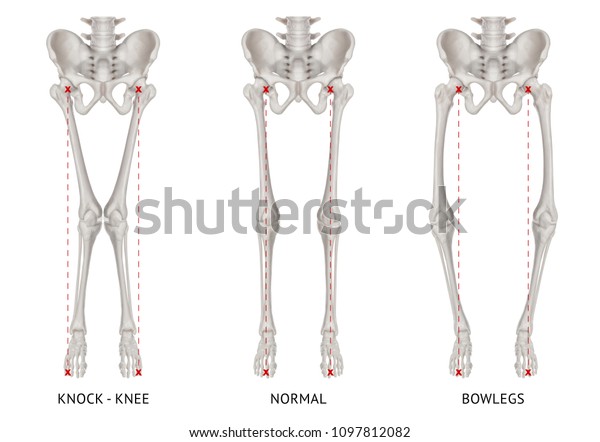 Normal Knee Alignment