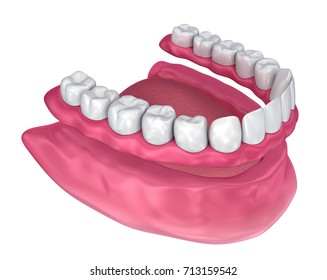 1,487 Removable partial denture Images, Stock Photos & Vectors ...