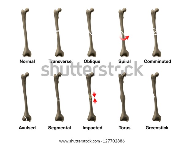 All Types Bone Fractures Anatomy Concept Stock Illustration 127702886