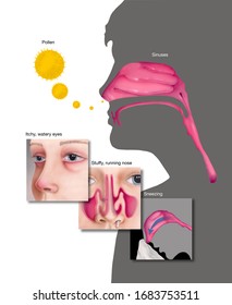 Sinusitis Symptoms Images Stock Photos Vectors Shutterstock Sinusitis Symptoms Images Stock Photos Vectors Shutterstock
