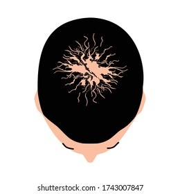 Alopecia Hair. Baldness Of Hair On The Head. Androgenic Alopecia. Infographics. Illustration On Isolated Background.