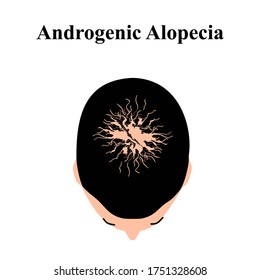 Alopecia Hair. Baldness Of Hair On The Head. Androgenic Alopecia. Infographics. Illustration On Isolated Background.