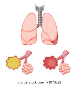 Diagram Showing Asthma Normal Asthmatic Airways Stock Illustration ...