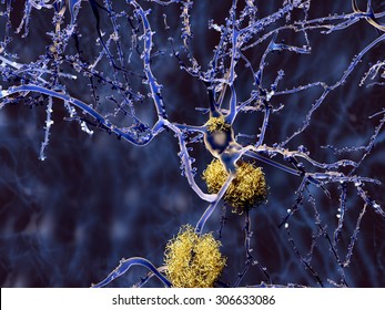 Alzheimer Disease: Neuron With Amyloid Plaques, 