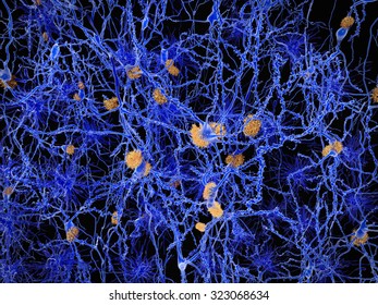 Alzheimer disease, neuron network with amyloid plaques