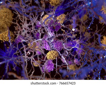 Alzheimer disease:
The yellow structures are amyloid plaques damaging neurons. The violet cells are microglia cells that phagocyte and degrade a sick neuron.
