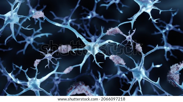 Alzheimer\'s disease, Amyloid plaques\
aggregates, 3d\
illustration