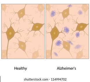 Alzheimer's Disease Brain Tissue With Amyloid Plaques Compared To Normal