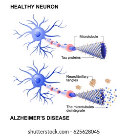 Alzheimer's Disease. Mechanism Of Disease. Diagram Shows Two Neurons: Healthy Cell And Neuron With Alzheimer's Disease. Tau Hypothesis. Neurofibrillary Tangles