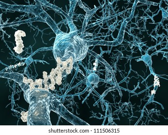 Alzheimer's disease - neurons with amyloid plaques