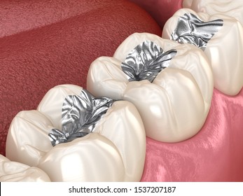 Amalgam restoration. Medically accurate 3D animation of dental concept
