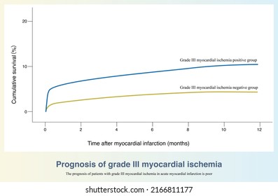 In AMI, patients with grade III myocardial ischemia on ECG suggest severe ischemia and poor long-term prognosis. V3-V4 leads S wave disappears or ST elevation amplitude beyond 50% R wave amplitude