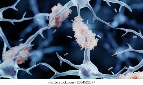 Amyloid plaque forming between neurons in Alzheimer's disease, 3d illustration