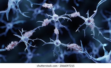 Amyloid plaques in Alzheimer's disease, 3d illustration