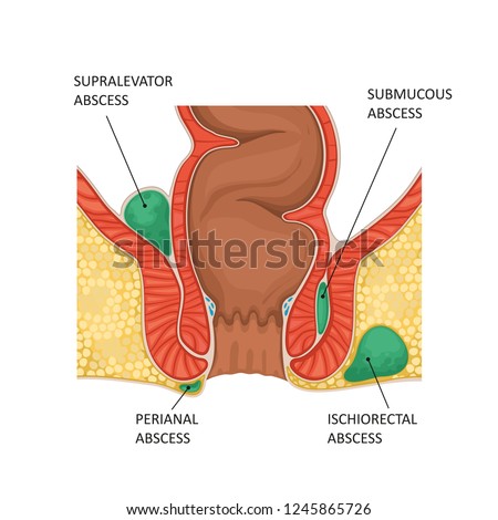 Only what is anal abscess Good, what is anal abscess excellent message