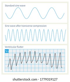 Analysis Of Ventricular Flutter Waves, A Fatal Ventricular Arrhythmia.