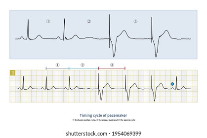 To Analyze The ECG Of Pacemaker, We Need To Know The Timing Cycle Of Pacemaker, Which Can Be Used To Judge Whether The Perception And Pacing Function Of Pacemaker Are Normal.