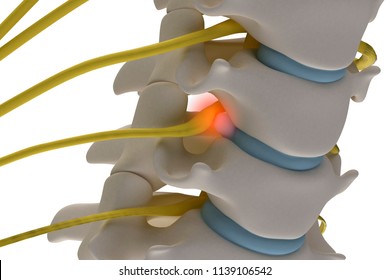 Anatomically Accurate 3d Image Of Cervical Spine With Prolapse Of Intervertebral Disc Compressive Nerve Root Isolated On White Background