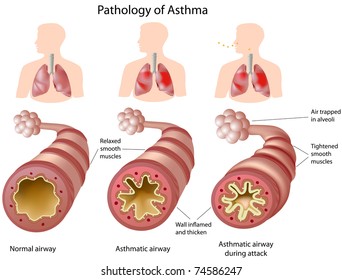 Anatomy Of Asthma