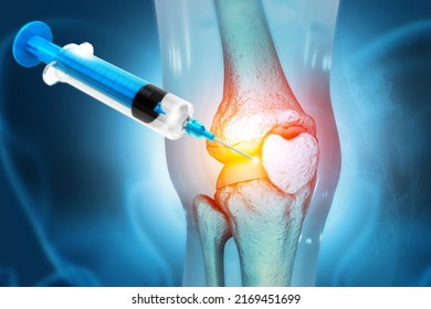 Anatomy Human Knee Joint Treatment, Osteoarthritis Injection, Drug Method Injection, knee injury, 3d illustration - Powered by Shutterstock