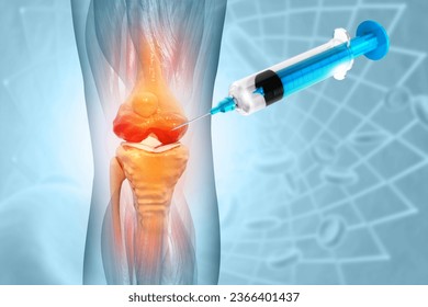 Anatomy Human Knee Joint Treatment, Osteoarthritis Injection, Drug Method Injection, knee injury, 3d illustration - Powered by Shutterstock