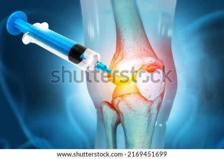 Anatomy Human Knee Joint Treatment, Osteoarthritis Injection, Drug Method Injection, knee injury, 3d illustration Foto stock © 