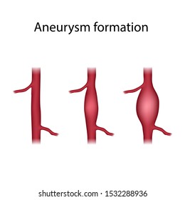 Aneurysm Images, Stock Photos & Vectors | Shutterstock