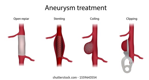 define aneurysm clipping