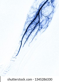 Angiography of brachial artery or fluoroscopic image of Vessel in the arm isolated on white background  in intervention radiology room.