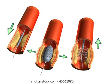 Angioplastic operation for the therapy of an arterial plaque. Digital illustration, clipping path included.