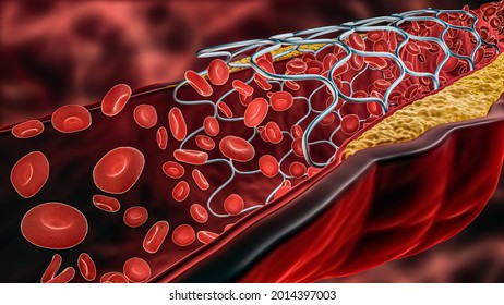 Angioplasty 3D rendering illustration. Deployed Stent within a diseased artery or blood vessel clogged by cholesterol or atheroma plaque with blood flow. Surgery, cardiology,  science concepts.