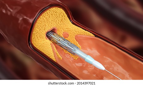 Angioplasty 3D rendering illustration. Stent delivery with collapsed balloon within a diseased artery or blood vessel clogged by cholesterol or atheroma plaques. Surgery, medicine, cardiology concept.