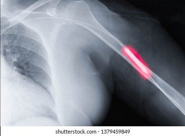 Angioplasty, Balloon Angioplasty And Percutaneous Transluminal Angioplasty (PTA) On Left Arm.