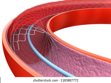 Angioplasty with stent. 3d render