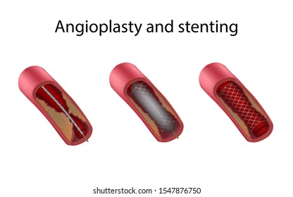 Angioplasty and stenting stages. Medical anatomy illustration.
