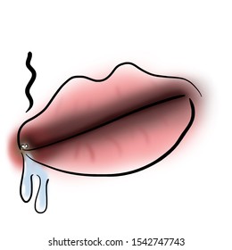 Angular Cheilitis In The Right Corner Of The Mouth