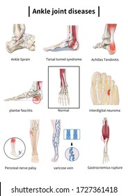 Ankle Joint Diseases Medical Illustration Stock Illustration 1727361418 ...
