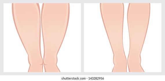 615 Fat ankle Images, Stock Photos & Vectors | Shutterstock