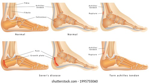 Ankleside View Ankle Disease Calcaneal Apophysitis Stock Illustration ...