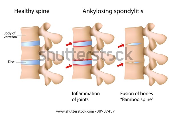 脊椎の強直性脊椎炎 のイラスト素材 7437