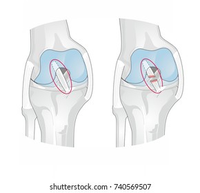 The anterior cruciate ligament (ACL) of the knee is injured usually during sports and activities.