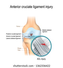 Anterior Cruciate Ligament Injury. Joint Anatomy. Illustration For Biological, Medical, Science And Educational Use