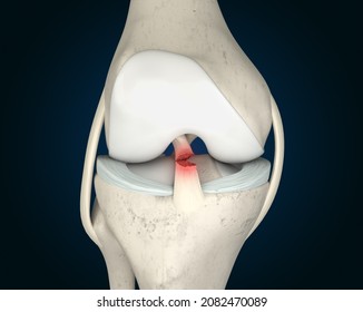 Anterior Cruciate Ligament Tear 3D Rendering, ACL Tear, ACL Injury, ACL Rupture, Knee Anatomy, Knee Pain, Knee Injury, 3D Illustration