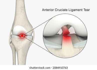 Anterior Cruciate Ligament Tear 3D Rendering, ACL Tear, ACL Injury, ACL Rupture, Knee Anatomy, Knee Pain, Knee Injury, 3D Illustration