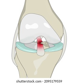 Anterior Cruciate Ligament Tear 3D Rendering, ACL Tear, ACL Injury, ACL Rupture, Knee Anatomy, Knee Pain, Knee Injury, 3D Illustration