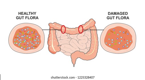 Antibiotics Or Wrong Diet Damage The Good And Bad Bacteria Flora Living In The Gut.