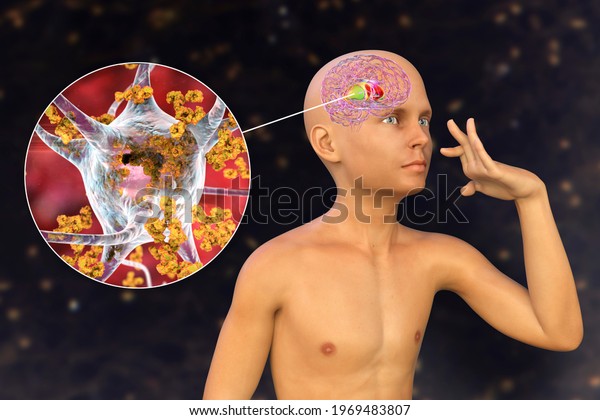 Anti-neuronal antibodies, anti-basal ganglia\
antibodies. 3D illustration shows immunoglobulins attacking neurons\
in the dorsal striatum of a boy\'s brain. They are found in\
post-rheumatic fever\
chorea