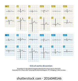 Aortic Dissection Important Differential Diagnosis Acute Stock ...